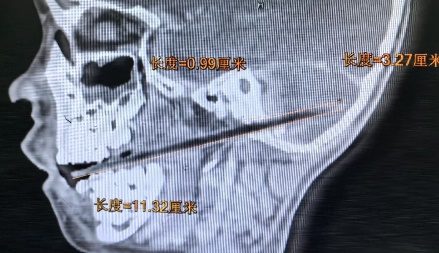 揪心，6岁男童口含麦芽糖摔倒，被竹签刺入小脑